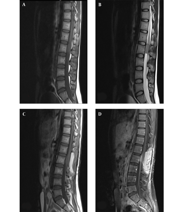Midline sagittal magnetic resonance imaging of the lumbar spine; A, Preoperative T1- weighted; and B, T2-weighted imaging demonstrate an intramedullary mass with abnormal signal in anterior thecal sac, measuring 29 × 15 mm at the L2 level; C, Postoperative T1-weighted; and D, T1-weighted with contrast imaging demonstrating residual tumor, with abnormal enhancement in left anterolateral aspect of posterior side of thecal sac and cord with extension to neural foramina and left neural canal at the L1/L2 level.