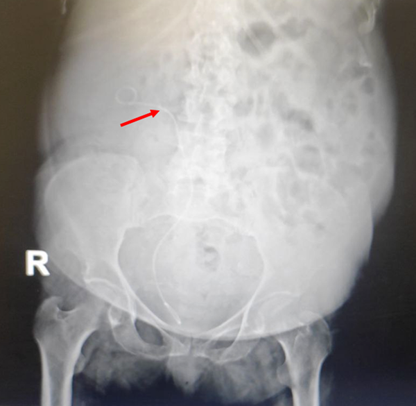 Double J was passed through the ureteral stricture and inserted in the ureter and right kidney (arrow).