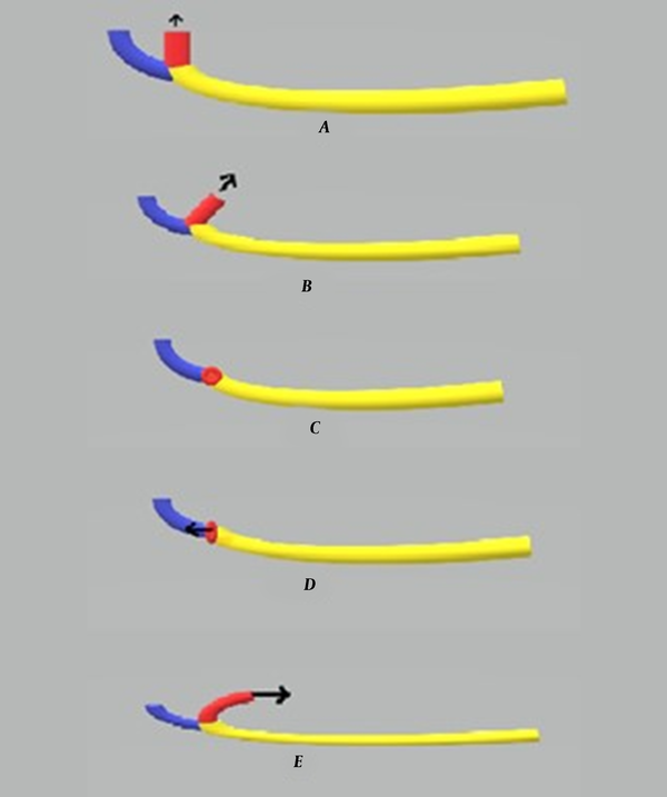 Pattern of opening of the mandibular canal in the mental foramen (A) Superiorly, (B) Superiorly-posteriorly, (C) Labially, (D) Anteriorly, and (E) Posteriorly.
