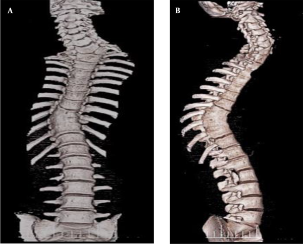 Three-dimensional (3D) reconstruction of CT scan coronal (A) and, sagittal (B). Showing the apex of kyphosis at T9 and apex of scoliosis at T1, with left hemi-vertebrae at C7-T1.