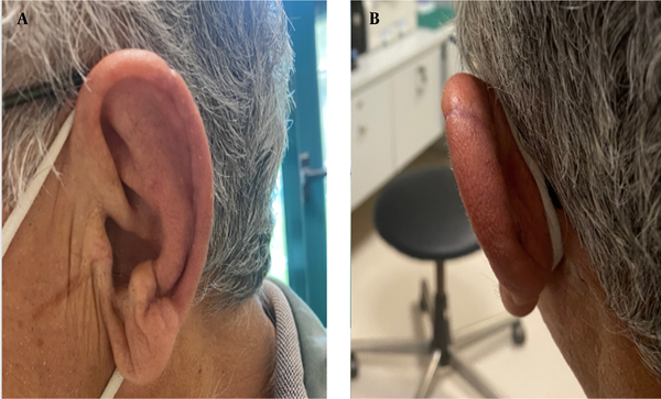 Patient presentation one month after the intervention. An excellent cosmetic outcome can be noticed. A, anterior; B, posterior