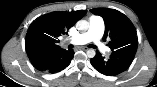 CT pulmonary angiography (CTPA) of a male patient with central pulmonary embolism (PE). The right main pulmonary artery is completely occluded (right arrow). In the left main pulmonary artery, however, the occlusion is partial (left arrow). The calculated Qanadli score is 30 (10 × 2 + 10 × 1).