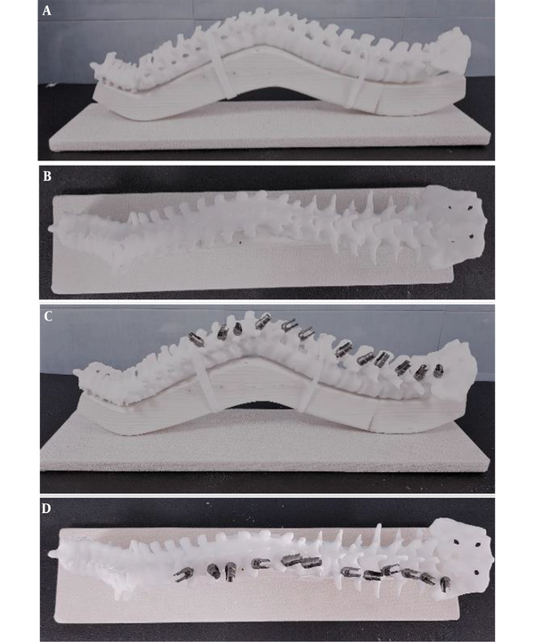 Three-dimensional (3D) printed moulage of spine, without pedicle screws sagittal (A) and coronal (B), after insertion of pedicle screws on one side, sagittal (C) and coronal (D) view.