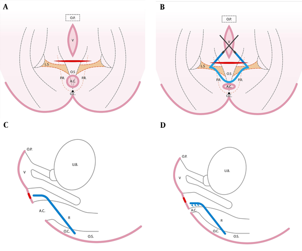 (A) The transverse perineal incision; the pelvic floor view in the lithotomy position. Abbreviations: O.P.: pubic bone, V: vagina, O.S. sacral bone, O.C.: coccygeal bone, A.C.: anal canal, L.S.: sacrospinous ligaments, P.R.: puborectalis muscle. (B) After inserting the mesh, it was sutured to both sacrospinous ligaments anterior to the anorectal junction; pelvic floor view in the lithotomy position. Abbreviations: O.P.: pubic bone, V: vagina, O.S. sacral bone, O.C.: coccygeal bone, A.C.: anal canal, L.S.: sacrospinous ligaments, P.R.: puborectalis muscle. (C) Longitudinal section of the pelvic floor showing the position of the mesh before tying the sutures to the sacrospinous ligaments. Abbreviations: O.P.: pubic bone, V: vagina, O.S. sacral bone, O.C.: coccygeal bone, A.C.: anal canal, U.B. urinary bladder, R: rectum. (D) Longitudinal section of the pelvic floor showing the position of the mesh after tying the sutures to the sacrospinous ligaments. Abbreviations: O.P.: pubic bone, V: vagina, O.S. sacral bone, O.C.: coccygeal bone, A.C.: anal canal, U.B. urinary bladder, R: rectum