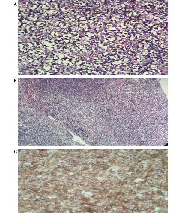Histologic features of tumor tissue; Hematoxylin and eosin staining (A, represents × 400 magnification; B, represents × 100 magnification) showing proliferation of cells with scant, sometimes clear cytoplasm with high mitosis and high atypia and areas of necrosis characteristic of malignant small round cell tumor; C, Positive staining for CD99, dot-like, paranuclear, and membranous pattern.
