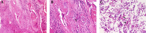A, Necrosis with severe acute inflammation and vasculitis, H&amp;E stain (× 100); B, Thrombosed vessels and fungal hypha in the vessel wall (black arrow), H&amp;E stain (× 250); C, Ribbon-like broad non-septate hyphae (black arrow), H&amp;E stain (× 250).