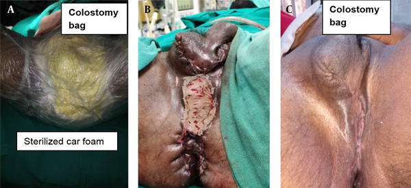 A, Modified NPWT application after laparoscopy-assisted transverse colostomy; B, After SSG; and C, Wound after 06 weeks.