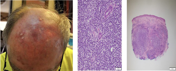 Clinical manifestation of primary cutaneous B-cell lymphoma as scalp erythema and nodules, and histopathology