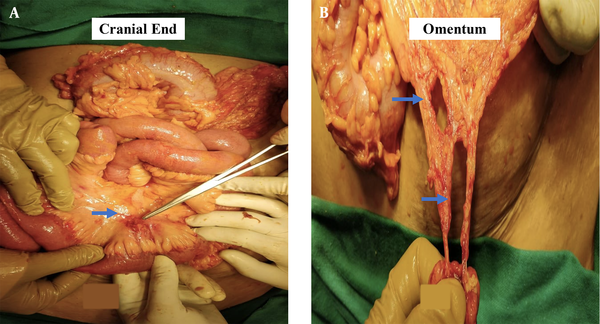 A, Intra-operative picture showing the exposed bowel loops with the blue arrow indicating the mesenteric tear; B, Intra-operative picture demonstrating the omental tears with blue arrows.