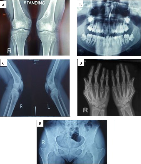 Radiologic bone changes. A, The lytic lesion with a well-defined sclerotic rim was observed in the distal metaphysis of the left femur, mostly suggestive of a non-ossifying fibroma; B, Oral cavity malocclusion without supernumerary teeth; C, There was no evidence of exostoses; D, Shortening of fourth and fifth metacarpal bones in both hands (more prominent on the right side) and the middle phalangeal bones of fingers combined with cone-shaped epiphyses; E, There was no hip involvement.