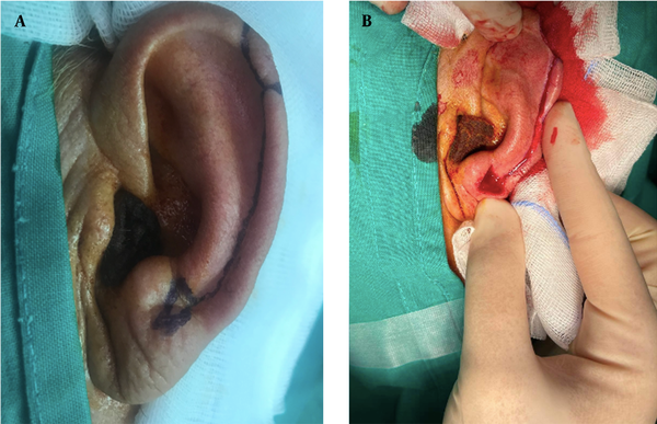 A, Designation of a helical advancement flap; B, flap after wide tumor excision