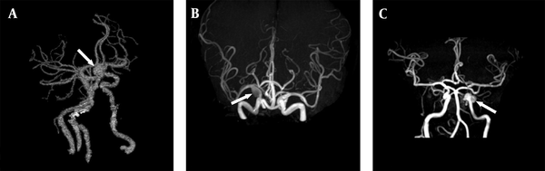 A, Brain CTA shows a left ICA aneurysm in a patient presented with SAH (white arrow); B, Brain MRA shows a right ICA aneurysm in a patient presented with an ischemic stroke (white arrow); C, Brain MRA shows a left ICA aneurysm in a patient presented with an ischemic stroke (white arrow).