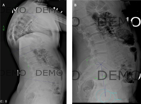 Spinopelvic measurements on digital radiographs of lateral whole spine (A) showing thoracic kyphosis of 61 and lumbar lordosis of 46; lateral lumbar (B) xray showing pelvic incidence: 56, pelvic tilt: 9 and sacral slope: 45.