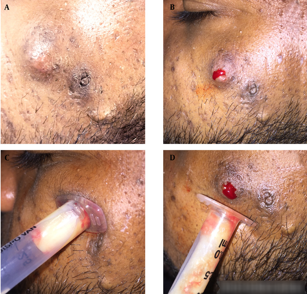 A, An Aseptically Prepared Cyst; B, Incision of a cyst on face with a hypodermic needle; C, Application of gentle pressure with syringe barrel over a cyst to drain the cyst; D, Drainage of cyst content in a syringe barrel.