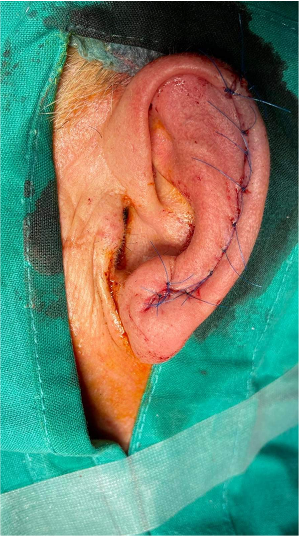 Tension-free closure of trauma Tension-free closure of trauma