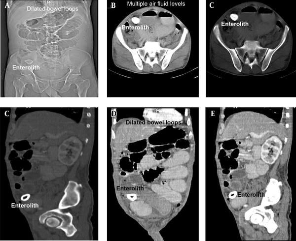 Images of CECT abdomen, showing small bowel obstruction with intra-luminal calculus in distal ileal loop right iliac fossa region in the zone of transition; A, scout film with stone in right-iliac-fossa; B, axial post-contrast CT: Intra-luminal stone with multiple air-fluid levels; C, axial post-contrast CT: Intra-luminal stone with multiple air-fluid levels; D, CECT abdomen (sagittal), showing enterolith with peripheral hyperdense calcification with hypodensity center; E, CECT abdomen (sagittal), showing dilated Jejunal, proximal and midileal loops (maximum caliber 4.5 cm); F, CECT abdomen (sagittal), showing collapsed distal ileal loops.