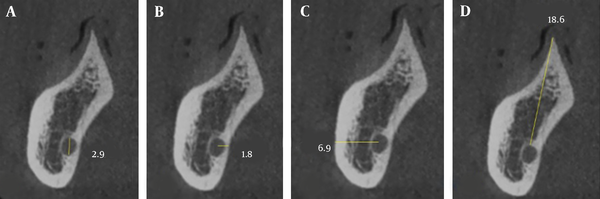 Mandibular canal (MC) variations; (A) Mean diameter of the MC; (B) Mean distance from the center of the MC to the lingual cortical plate; (C) Mean distance from the center of the MC to the buccal cortical plate; (D) Mean distance between the superior part of the MC and the alveolar crest