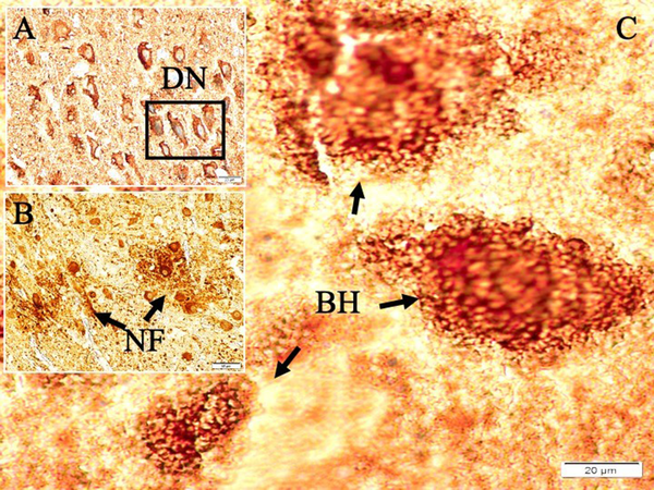 Histopathological appearances of A, a degenerated neuron (DN); B, Lewy bodies with misfolded alpha-synuclein proteins (white arrows) believed to be an indicator factor in Parkinson’s disease (L, Alphasynuclein, × 40) in the study group