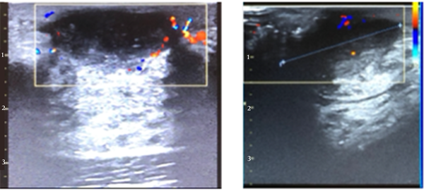 Breast abscess in a lactating breast (left) and a nonlactating breast (right); ultrasound shows a hypoechoic collection with irregular margins, demonstrating peripheral vascularity on Colour Doppler.
