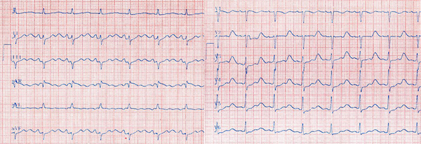 12-lead electrocardiogram revealed normal sinus rhythm with prolonged QT interval (QTc interval = 0.63 sec).