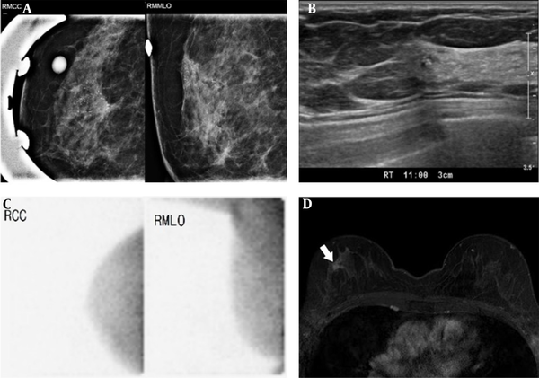 DCIS of the right breast in a 62-year-old woman. The right craniocaudal (CC) and mediolateral oblique (MLO) images. A, Show regionally distributed, fine pleomorphic, and linear branching microcalcifications in the right upper outer breast (BI-RADS 4c). Breast US (B) shows ill-defined, hypoechoic parenchymal changes with echogenic dots in the right breast at the corresponding location on MMG (BI-RADS 4c). However, BSGI (C) shows no focal uptake in the right breast. The breast MR image (D) shows an enhancing mass (1.9 × 1.1 × 1.9 cm) (arrow) in the right breast (DCIS, ductal carcinoma in situ; BSGI, breast-specific gamma imaging; US, ultrasonography; MMG, mammography).
