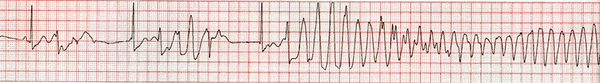 The rhythm strip illustrates short-coupled premature ventricular contraction in a pattern of bigeminy that triggered Torsades de Pointes.