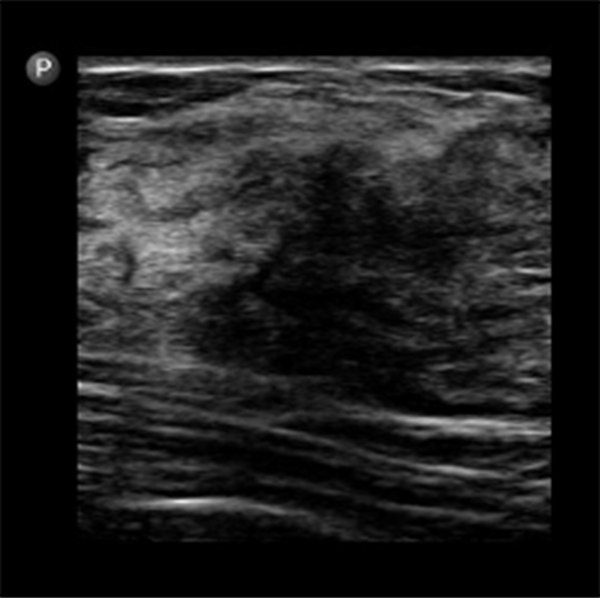 Ultrasound showing an ill-defined hypoechoic area within the fibroglandular tissue; this case was histologically confirmed as a fibrocystic change.
