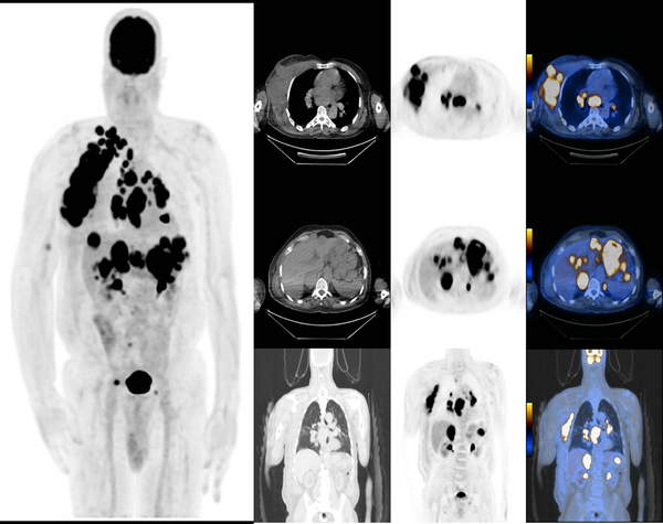 A very aggressive case of melanoma with extensive lung, liver, and lymph node metastases. The maximum intensity projection (MIP) image is on the left, and the selected axial and coronal images on the right are merged together.