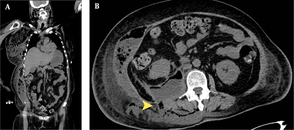 A, The follow-up CT scan from the neck to pelvis shows perirenal and pararenal hematoma of the right kidney with abscess formation, involving the right psoas muscle and the right paraspinal region after one week of conservative treatment. Necrotizing fasciitis involves groups of muscles in the right lateral and posterior abdominal wall, right axillary region, supra- and infra-clavicular regions, right breast, right arm, bilateral upper anterior chest wall, and right side of the neck. B, The perirenal and pararenal abscess spreads to the paraspinal region (yellow arrowhead) and invades the subcutaneous tissue. Necrotizing fasciitis occurs through upward and downward invasion to the adjacent structures.