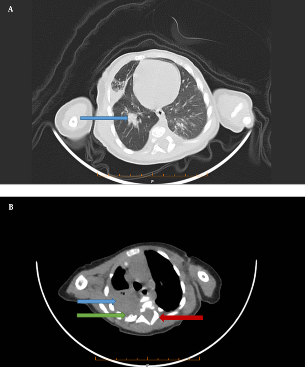 A, A lung view of computed tomography shows a mass (34 × 27 mm) in the middle lobe of the right lung (Blue Arrow). B, Mediastinal view of computed tomography shows a mass in the posterior mediastinum (Blue Arrow), Periosteal reaction in (Green arrow), and neural foramen widening (Red arrow), which all can be in favor of neuroblastoma.