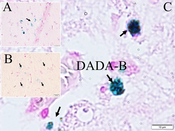 Iron-loaded neurons in A, a normal (black arrow; LM, Prussian Blue, × 10); B, in a sham (black arrows; LM, Prussian Blue, × 10); and C, dense and giant iron-loaded cores forming data destructing amyloid black holes (DADA-B) (black arrows, LM, Prussian Blue, × 100) are seen in a study rat.