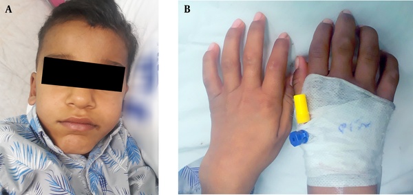 A, Face deformities include a long face with a prominent forehead and chin and a short neck; B, Claw hand deformity.