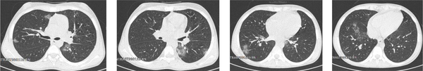 Mixed multifocal and peripheral ground-glass opacities and round/linear consolidations in Chest CT scan of Case No. 4