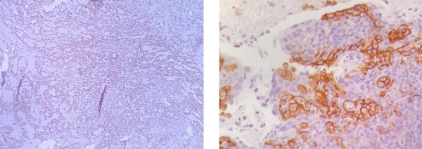 PD-L1 expression in renal cell carcinoma (Left: X40 and right: X400)