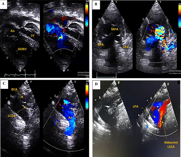 Transthoracic echocardiogram revealed; A, Double outlet right ventricle (DORV), small-sized left ventricle (LV), small-sized mitral valve annulus; B, Sever main pulmonary artery (MPA) stenosis (Valvular, supravalvular), small-sized left pulmonary artery (LPA); C, Right-sided Aortic arch, with two branches arising: Brachiocephalic artery (BCA) and left common carotid (LCC) artery; D, Aberrant left subclavian artery (LSCA) arising from the left pulmonary artery.