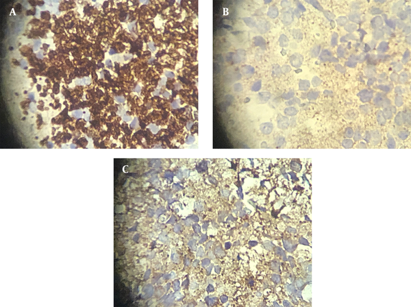 A, Positive chromogranin maker in IHC. B, Positive synaptophysin in IHC. C, Positive neuron-specific enolase (NSE) maker in IHC.
