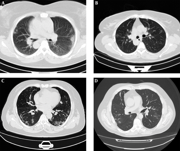The computed tomography scans (CT) of patients infected with coronavirus disease 2019 (COVID-19) for the first (A) and second (B) public datasets, COVID19-P20 dataset (8) (C), and MosMedData dataset (25) (D). Visual differences in chest CT characteristics (e.g., spatial resolution, noise, and contrast) suggest the importance of generalization analysis in deep learning-based models.