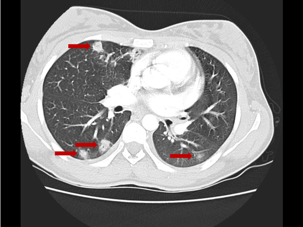 Thoracic computerized tomography angiography (transverse section): pulmonary septic emboli throughout the pulmonary parenchyma (arrows), some of which present a “feeding vessel” sign.