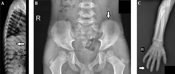 A, Central beaking, and bullet shape appearance in the cervical and lumbar vertebra; B, Tapering of iliac wings, deformity of the femoral head, and short sacral length; C, Proximal tapering of metacarpals.
