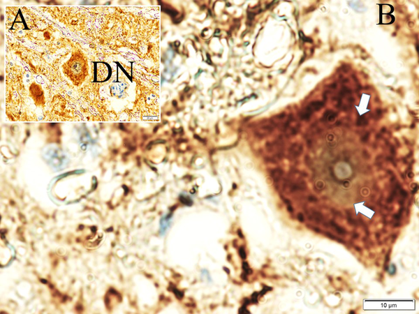 Histopathological appearances of A, a degenerated neuron (DN); B, Lewy bodies with misfolded alpha-synuclein proteins (white arrows) believed to be an indicator factor in Parkinson’s disease (L, Alphasynuclein, × 40) in the study group