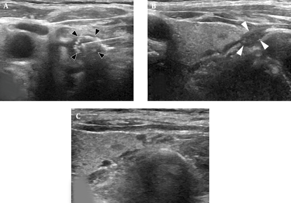 Subsequent RFA following EA. A, The ultrasound examination (axial plane) during the RFA procedure showed a radiofrequency electrode and echogenic ablation zone (black arrowheads); B, The ultrasound examination (longitudinal plane) showed that nodule size decreased (volume: 0.07 cc, white arrowheads) three months after RFA; C, The ultrasound examination (longitudinal plane) showed that the nodule completely disappeared two years later (RFA: radiofrequency ablation; EA: ethanol ablation).