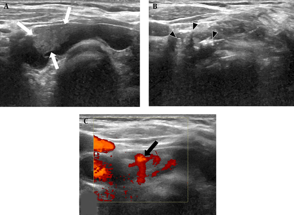 EA for a 77-year-old man with parathyroid adenoma. A, The ultrasound examination (axial plane) before EA showed a 3.5 cm (volume: 6.12 cc) circumscribed cystic mass with a solid component (white arrows) in the right lower thyroid bed; B, The ultrasound examination (axial plane) during the EA procedure showed multiple tiny echogenic bubbles with reverberating artifacts (black arrowheads) in cystic and solid components; C, Power Doppler examination (axial plane) revealed a remaining solid component with an arc of vessels two months after EA (black arrow) (EA, ethanol ablation).