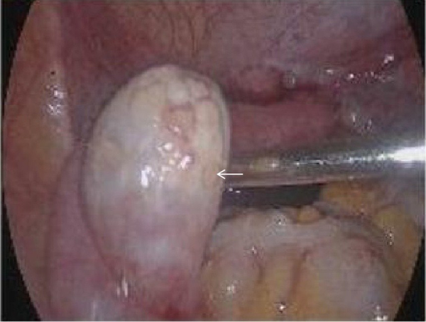 Laparoscopic bilateral gonadectomy. The uterus seen during surgery is significantly smaller than normal. The diameter of the left gonadal tissue is about 3 cm (white arrow), and the diameter of the right gonadal tissue is about 0.5 cm.