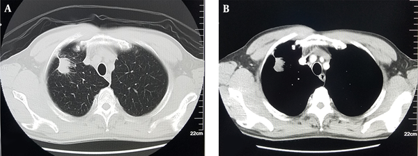 A 66-year-old male patient with a body mass index (BMI) of 23.7 kg/m2. The enhanced chest CT scan (120 kVp, 350 mgI/mL of contrast agent, FBP) scored five points in the subjective evaluation of image quality. A, Lung window: The lung window clearly shows the edge of the nodule lesion which is not smooth, along with the burr sign and the pleural depression sign; B, Mediastinal window: The lesion is significantly enhanced with a pleural depression sign (FBP, filter back projection).