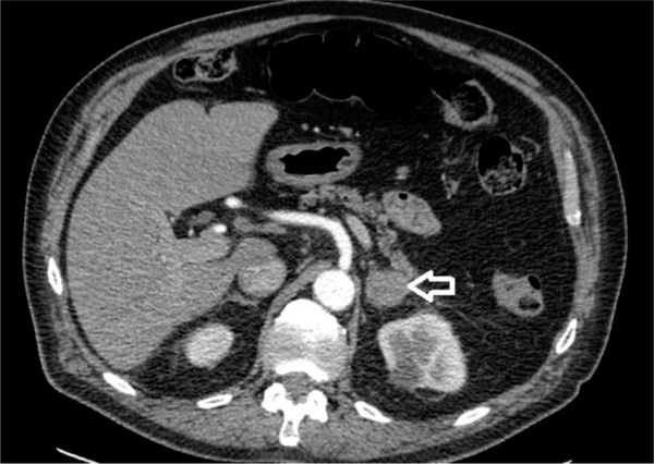 Computerized tomography of abdomen showing a 27-mm left adrenal nodule of a 77-year-old patient with previous diagnosis of diffuse large B cell non-Hodgkin’s lymphoma