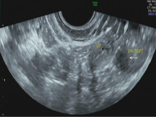 Transrectal ultrasound gynecological examination indicates that the volume of the uterus is smaller than normal (black arrow) and that there is a hypoechoic mass in the left adnexal area; the gonadal tissue may be associated with calcification (white arrow).