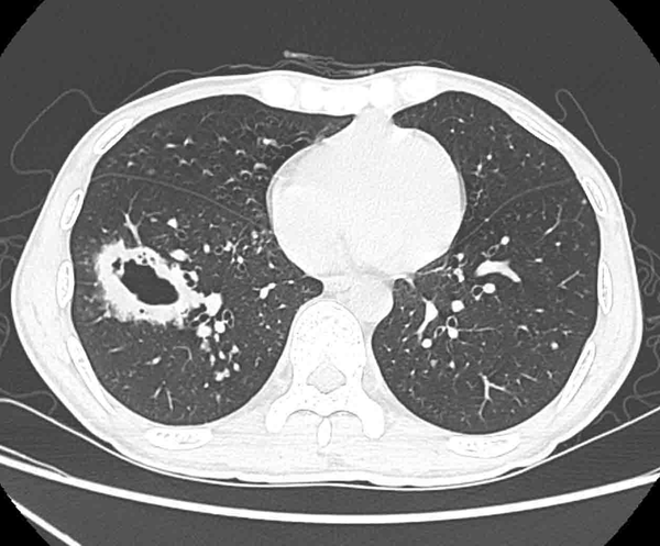 A 27-year-old HIV-infected man with pulmonary cryptococcosis (PC) and a representative thick-walled cavity lesion confirmed by pathology. In the right lower lobe, lesion with irregular thick-walled and line-shaped shadows had an unclear border with the normal lung, while small nodules with sharp borders mixed with ground-glass opacity around the cavity are detected.