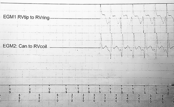 Example of ventricular tachycardia with a Q pattern in the far-field electrogram