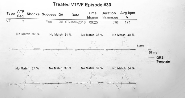 Example of calculating the matching percentage. The average morphologic match between the last eight ventricular complexes during VT rhythm prior to detection and the stored native QRS morphology was defined as a matching percentage. According to this tracing, the matching percentage averages 37, 34, 37, 40, 37, 37, 37, and 34%. So it is equal to 36.6%