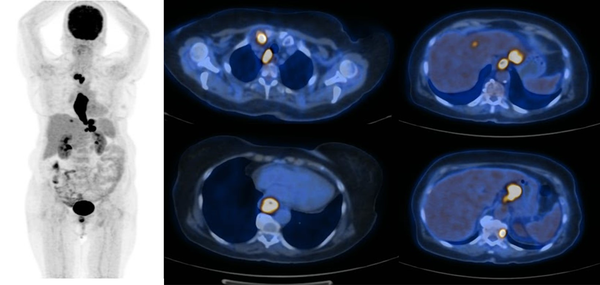 The maximum intensity projection (MIP) and axial PET/CT images of a patient with esophageal squamous cell carcinoma (SCC). There is a primary esophageal elongated tumor, regional mediastinal hypermetabolic lymph nodes, and distant hypermetabolic metastases of the liver and bone.